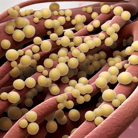 Gronkowiec – jak przebiega zakażenie, objawy, leczenie