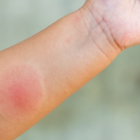 Jak łagodzić ukąszenia owadów?