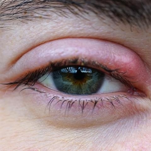 Jęczmień na oku – jak go rozpoznać i jak postępować?