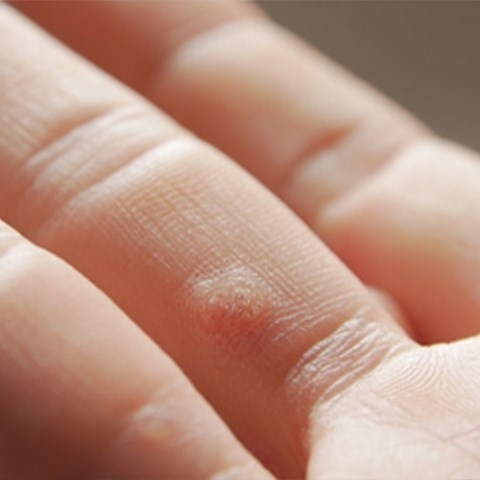 Kurzajki – jak się ich pozbyć, domowe sposoby i leczenie