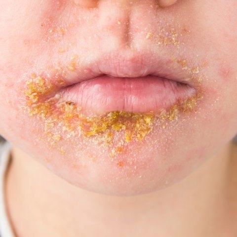 Liszajec zakaźny - co to za choroba? Leczenie, przyczyny i czynniki sprzyjające zakażeniu