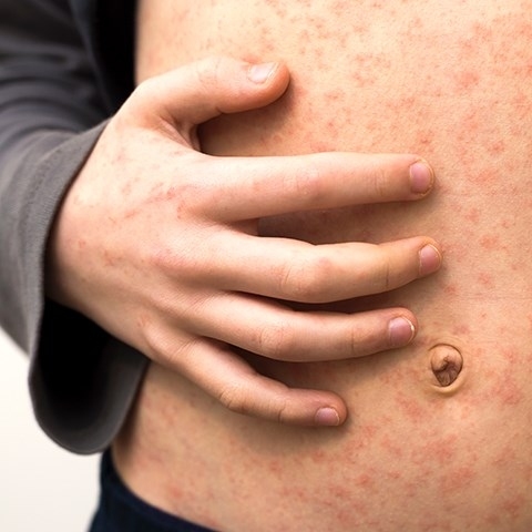 Odra: wyjątkowo zaraźliwa