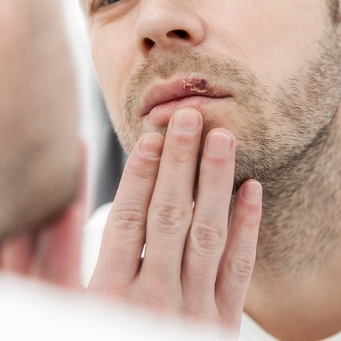 Opryszczka – przyczyny, objawy, leczenie, jak zapobiegać?