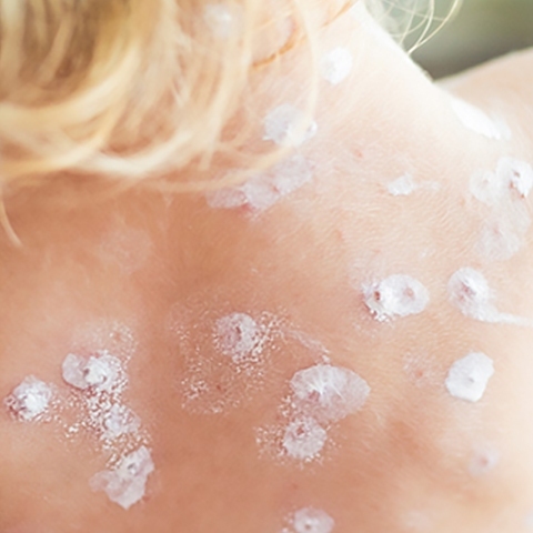 Ospa – kto może się zarazić? Czy jest niebezpieczna?