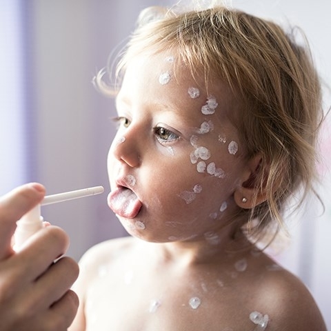 Ospa wietrzna u dzieci – przyczyny, objawy, leczenie