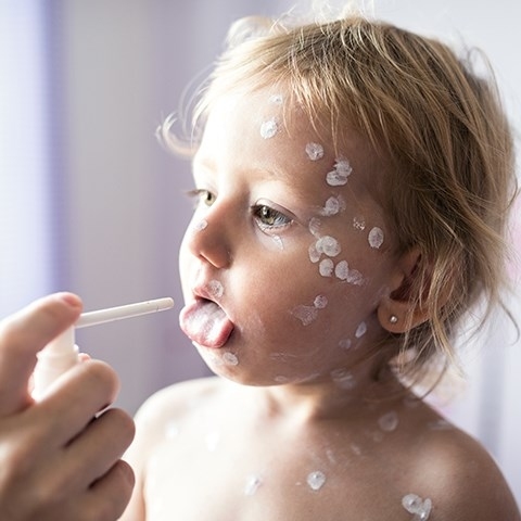 Półpasiec i ospa – różne choroby, ta sama przyczyna