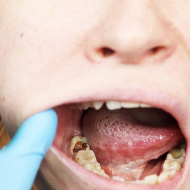 Próchnica zębów - jak powstaje? Zapobieganie i leczenie próchnicy