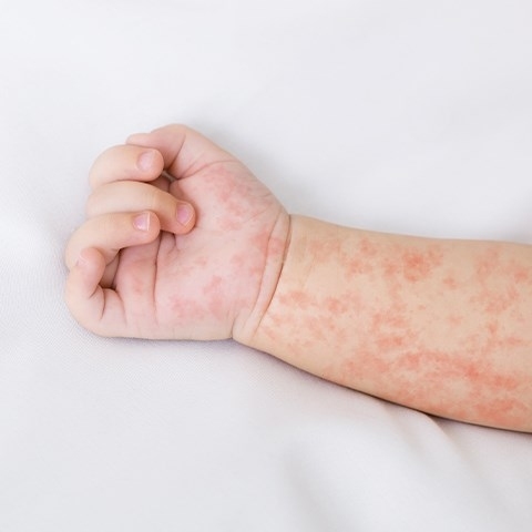 Róża (choroba skóry) – co ją wywołuje i jak wygląda leczenie?