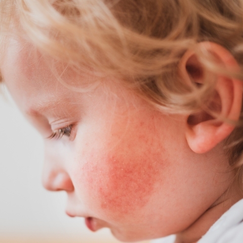 Skaza białkowa – czym jest i jak sobie z nią radzić?