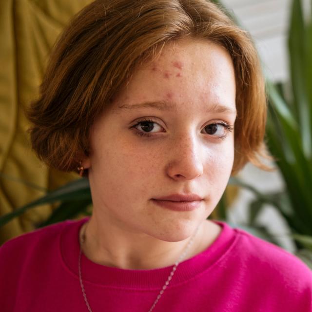 Stres a skóra: jak emocje wpływają na Twoją cerę?