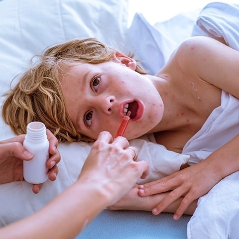 Szkarlatyna (płonica) – objawy i przyczyny. Jak leczyć szkarlatynę?